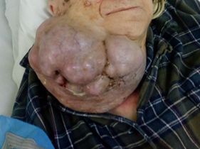 Гигантски карцином в плеоморфен аденом беше отстранен в столичната СБАЛО